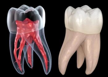 điều trị tủy răng tại hoàn mỹ sài gòn