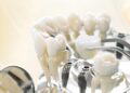 Cách lựa chọn nha khoa Implant uy tín