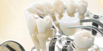 Cách lựa chọn nha khoa Implant uy tín