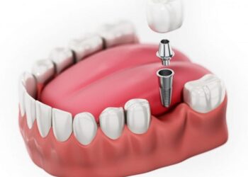 có nên trồng răng implant giá rẻ không