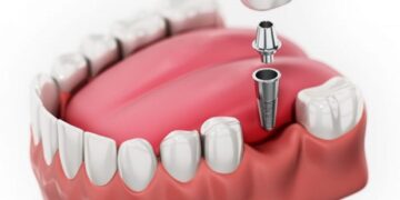 có nên trồng răng implant giá rẻ không