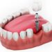 có nên trồng răng implant giá rẻ không