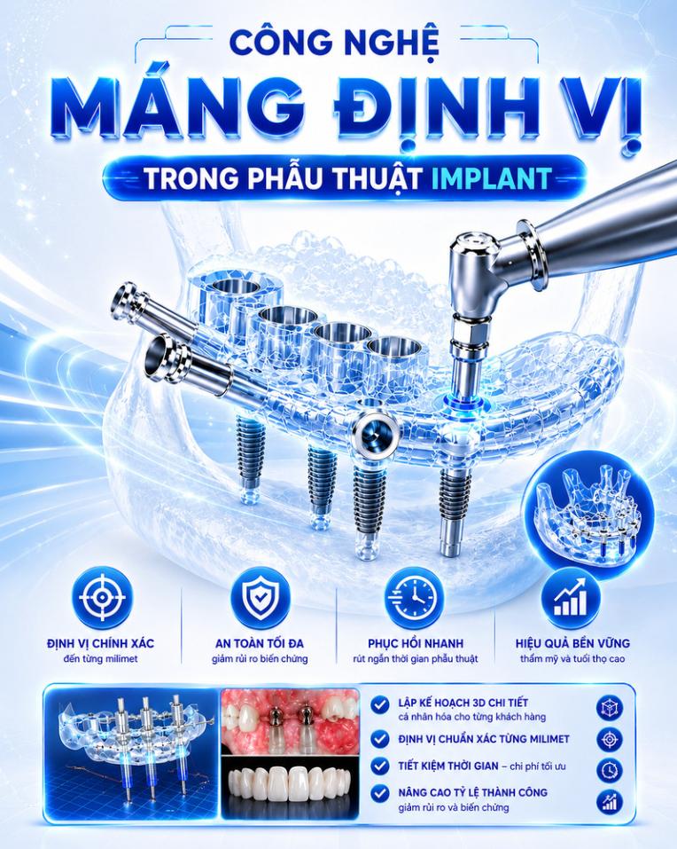 Công nghệ máng định vị phẫu thuật trong implant