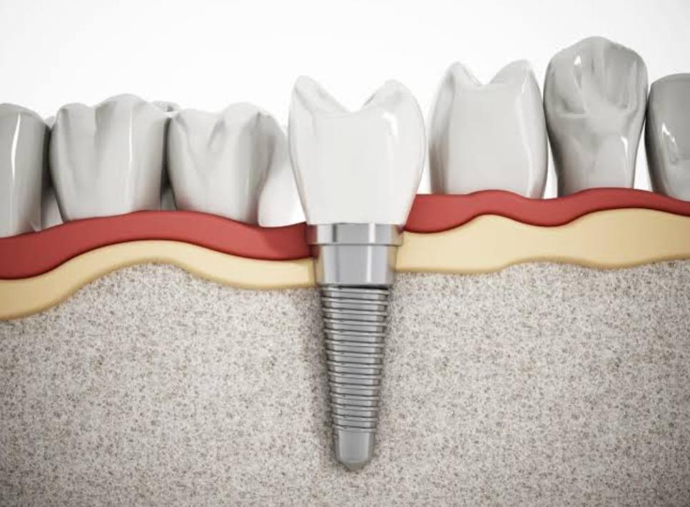 Trồng răng implant giá rẻ không đảm bảo chất lượng trụ Titanium nguyên chất