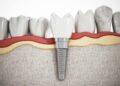 Các yếu tố ảnh hưởng đến chi phí trồng răng implant