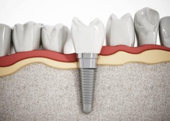 Các yếu tố ảnh hưởng đến chi phí trồng răng implant