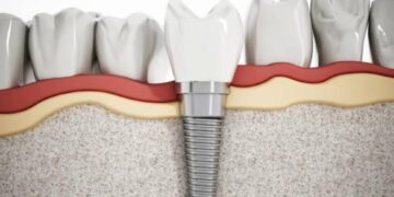Các yếu tố ảnh hưởng đến chi phí trồng răng implant