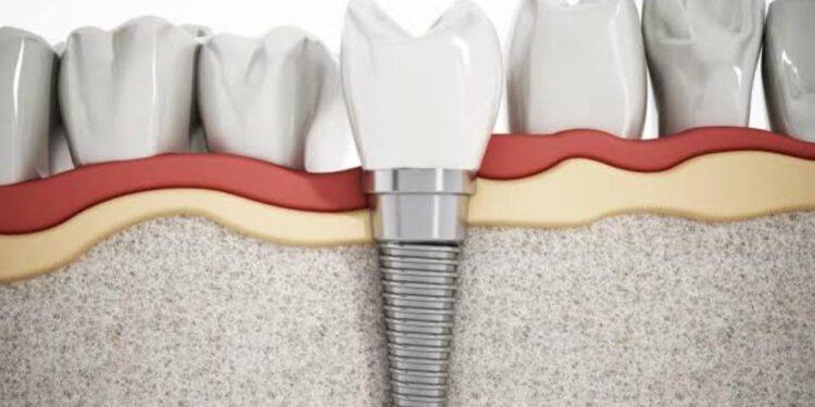 Các yếu tố ảnh hưởng đến chi phí trồng răng implant