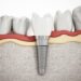 Các yếu tố ảnh hưởng đến chi phí trồng răng implant